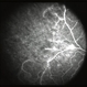 Lupus Vasculitis Angiogram